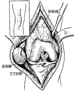股骨下段切除术图片