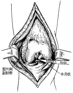 股骨下段切除术图片