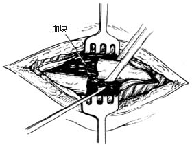骨折切开复位术图片