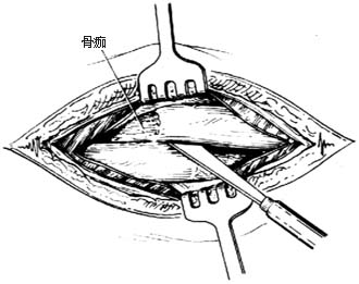 骨折切开复位术图片