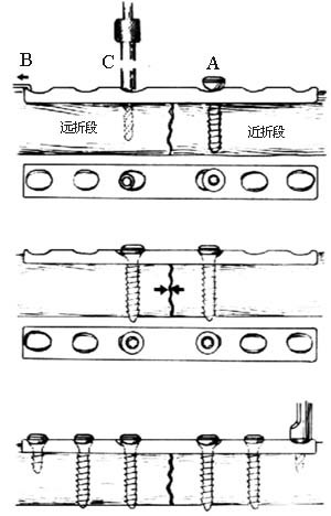 钢板螺钉内固定术图片