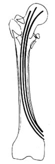 弧形髓内针（Ender针）内固定术图片