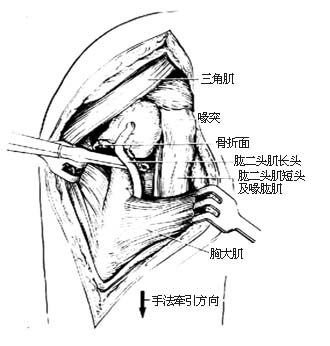 肱骨外科颈骨折切开复位内固定术图片