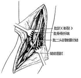 肱骨髁上骨折切开复位内固定术图片