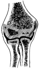 肱骨髁骨折切开复位内固定术图片