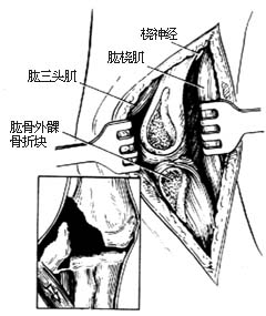 肱骨髁骨折切开复位内固定术图片