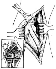 肱骨髁骨折切开复位内固定术图片