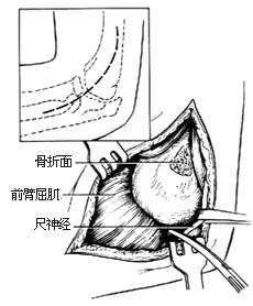 肱骨髁骨折切开复位内固定术图片