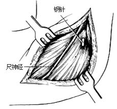 肱骨髁骨折切开复位内固定术图片