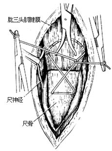 尺骨鹰嘴骨折切开复位内固定术图片