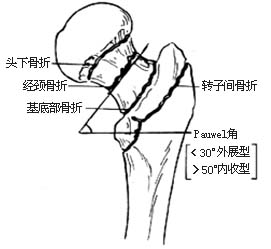 股骨颈骨折复位内固定术（三翼钉内固定术）图片