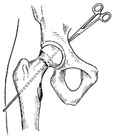 股骨颈骨折复位内固定术（三翼钉内固定术）图片