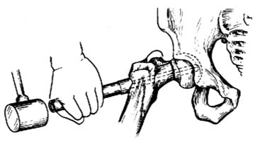 股骨颈骨折复位内固定术（三翼钉内固定术）图片