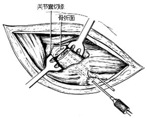 股骨颈骨折复位内固定术（三翼钉内固定术）图片