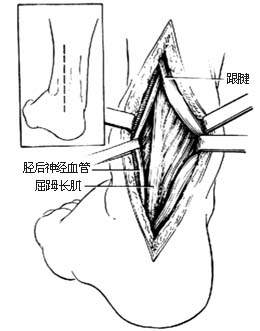 踝关节骨折切开复位内固定术图片