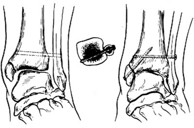 踝关节骨折切开复位内固定术图片
