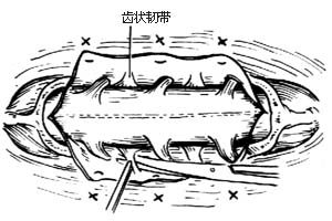 脊柱骨折脱位合并截瘫的手术图片