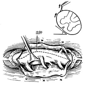 脊柱骨折脱位合并截瘫的手术图片
