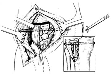 胫骨平台骨折切开复位内固定术图片