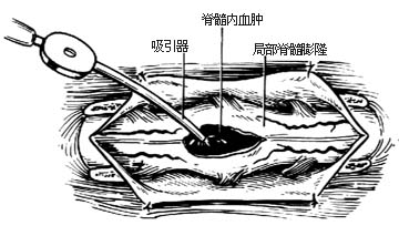 脊柱骨折脱位合并截瘫的手术图片