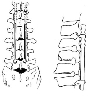 脊柱骨折脱位合并截瘫的手术图片