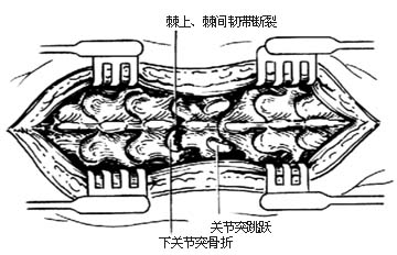 脊柱骨折脱位合并截瘫的手术图片