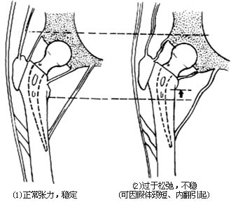 人工股骨头置换术图片