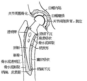 人工股骨头置换术图片