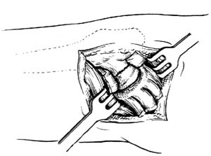 人工股骨头置换术图片