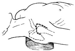 肩关节融合术图片