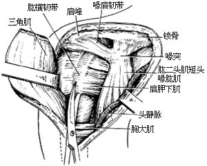 肩关节融合术图片