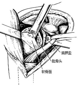 肩关节融合术图片