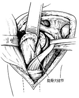 肩关节融合术图片