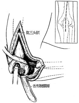 肘关节融合术图片