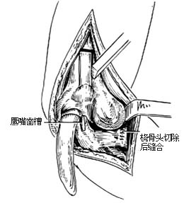 肘关节融合术图片