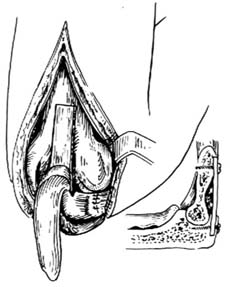 肘关节融合术图片