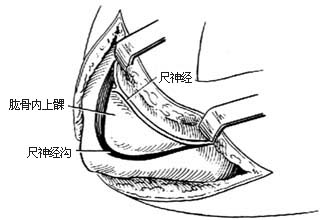 肘关节融合术图片