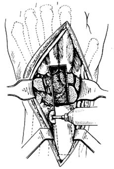 腕关节融合术图片