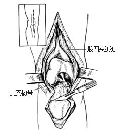 膝关节加压融合术图片