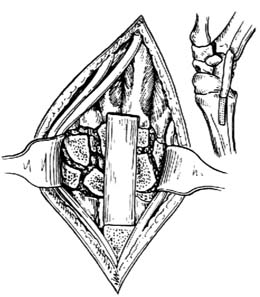 腕关节融合术图片