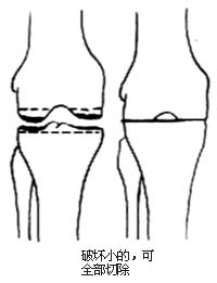 膝关节加压融合术图片