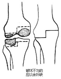 膝关节加压融合术图片