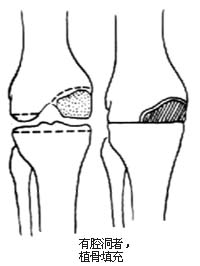 膝关节加压融合术图片