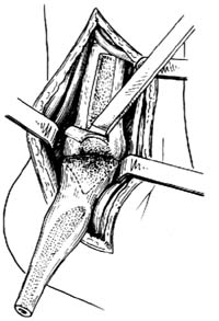 踝关节融合术图片