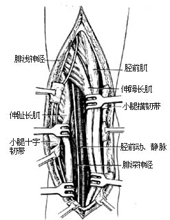 踝关节融合术图片