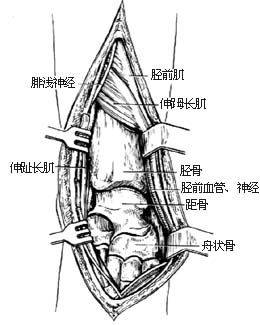 踝关节融合术图片