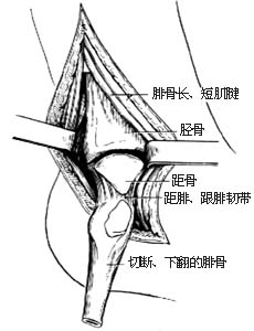 踝关节融合术图片