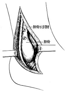 踝关节融合术图片