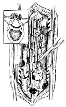 椎板融合术图片