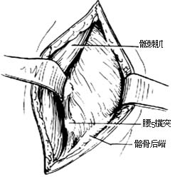 横突间融合术图片